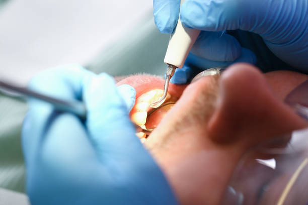 Best Emergency Dental Care for Abscessed Tooth in Kensington, CT